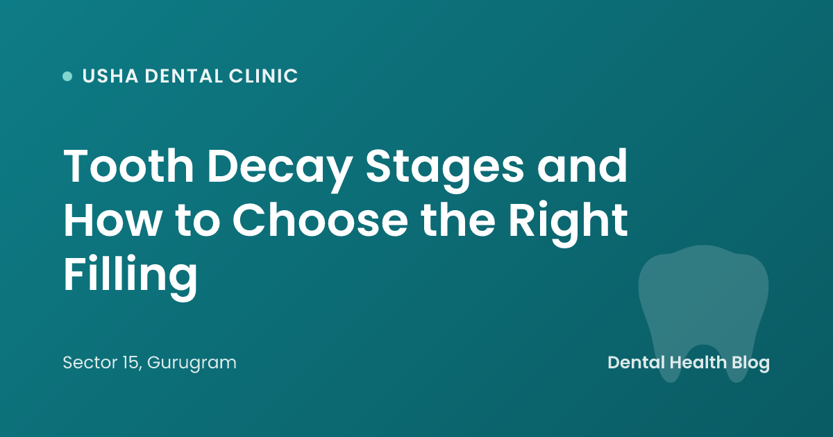 Tooth Decay Stages and How to Choose the Right Filling