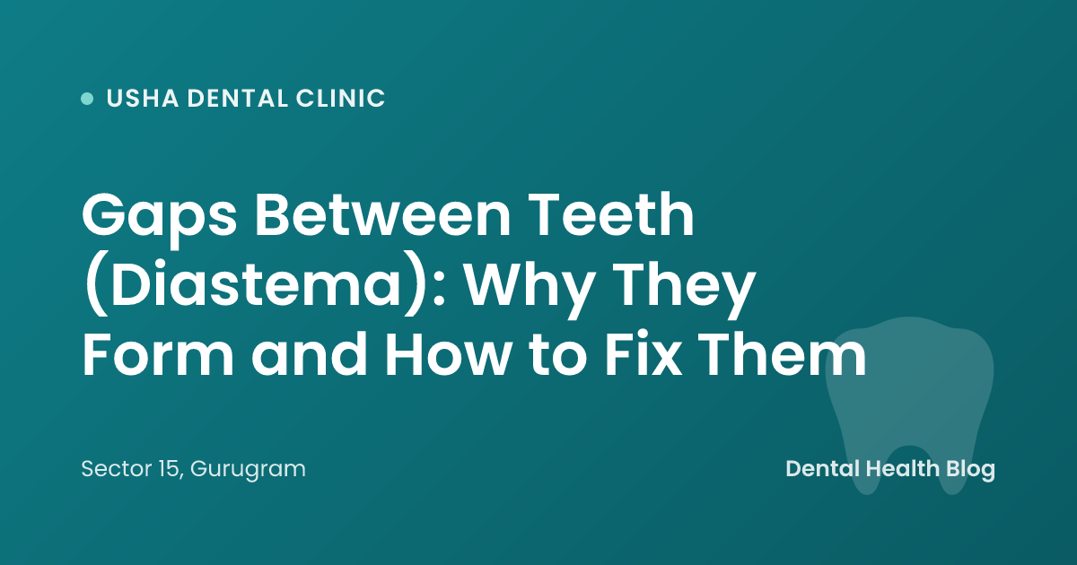 Gaps Between Teeth (Diastema): Why They Form and How to Fix Them
